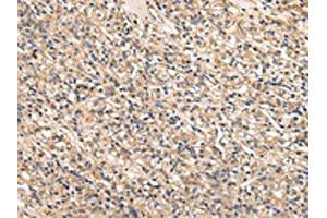 The image on the left is immunohistochemistry of paraffin-embedded Human prostate cancer tissue using ABIN7128011(SERPINA7 Antibody) at dilution 1/25, on the right is treated with fusion protein. (SERPINA7 抗体)