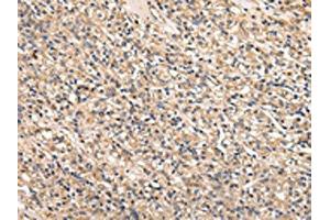 The image on the left is immunohistochemistry of paraffin-embedded Human prostate cancer tissue using ABIN7128011(SERPINA7 Antibody) at dilution 1/25, on the right is treated with fusion protein. (SERPINA7 抗体)