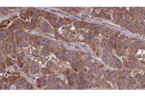 ABIN6277662 at 1/100 staining Human liver cancer tissue by IHC-P. (LSP1 抗体  (C-Term))