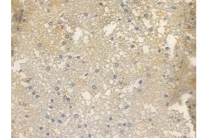 Phospho-mGluR5 (Ser870) Antibody at 1/100 staining human glioblastoma by IHC-P.