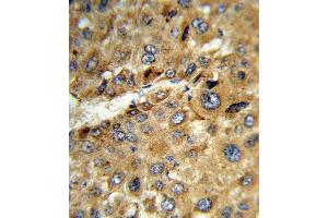 Formalin-fixed and paraffin-embedded human hepatocarcinoma reacted with TAT Antibody (Center), which was peroxidase-conjugated to the secondary antibody, followed by DAB staining. (Tat (AA 279-306) 抗体)