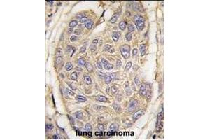 Formalin-fixed and paraffin-embedded human lung carcinoma tissue reacted with B2M antibody (C-term) (ABIN389259 and ABIN2839397) , which was peroxidase-conjugated to the secondary antibody, followed by DAB staining. (beta-2 Microglobulin 抗体  (C-Term))