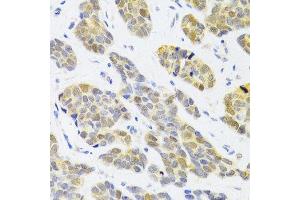 Immunohistochemistry of paraffin-embedded human breast cancer using RFC4 Antibody.