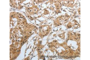 Immunohistochemistry of Human lung cancer using AMPH Polyclonal Antibody at dilution of 1:30 (Amphiphysin 抗体)