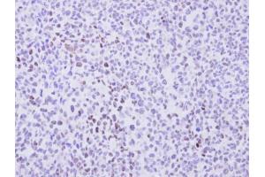 IHC-P Image Immunohistochemical analysis of paraffin-embedded H1299 Xenograft, using cyclin T2, antibody at 1:100 dilution. (Cyclin T2 抗体  (C-Term))