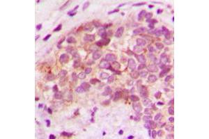 Immunohistochemical analysis of BRP44L staining in human breast cancer formalin fixed paraffin embedded tissue section. (BRP44L 抗体  (N-Term))