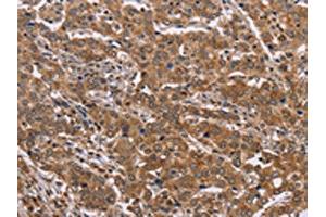 The image on the left is immunohistochemistry of paraffin-embedded Human liver cancer tissue using ABIN7129424(FAAH2 Antibody) at dilution 1/30, on the right is treated with fusion protein. (FAAH2 抗体)