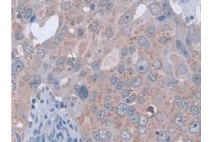 Detection of D2HGDH in Human Breast cancer Tissue using Polyclonal Antibody to D2-Hydroxyglutarate Dehydrogenase (D2HGDH) (D2HGDH 抗体  (AA 56-232))