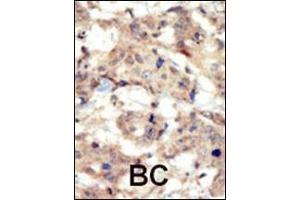 Formalin-fixed and paraffin-embedded human cancer tissue reacted with the primary antibody, which was peroxidase-conjugated to the secondary antibody, followed by DAB staining. (EPH Receptor B6 抗体  (N-Term))