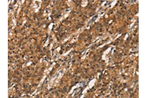 The image on the left is immunohistochemistry of paraffin-embedded Human gastric cancer tissue using ABIN7189855(APOC4 Antibody) at dilution 1/20, on the right is treated with synthetic peptide. (APOC4 抗体)