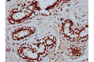 IHC image of ABIN7173536 diluted at 1:400 and staining in paraffin-embedded human breast cancer performed on a Leica BondTM system.