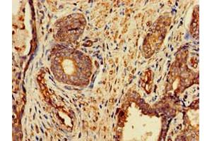 Immunohistochemistry of paraffin-embedded human prostate cancer using ABIN7153175 at dilution of 1:100 (FZD1 抗体  (AA 73-322))