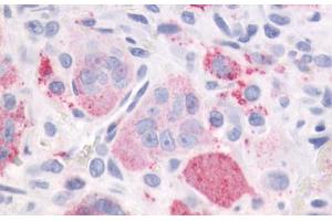 Anti-PTHR / PTHR1 antibody IHC staining of human bone, giant cell tumor. (PTH1R 抗体  (Internal Region))