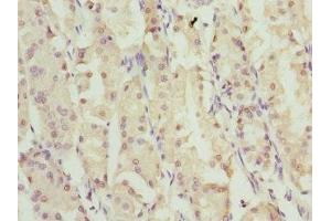 Immunohistochemistry of paraffin-embedded human gastric cancer using ABIN7176368 at dilution of 1:100