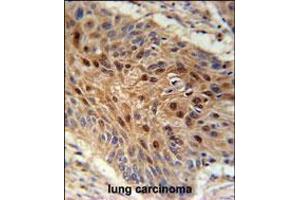 C4orf31 Antibody immunohistochemistry analysis in formalin fixed and paraffin embedded human lung carcinoma followed by peroxidase conjugation of the secondary antibody and DAB staining. (NDNF 抗体  (N-Term))
