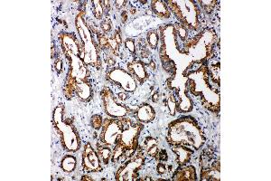 Anti-Tollip antibody, IHC(P) IHC(P): Human Prostatic Cancer Tissue (TOLLIP 抗体  (C-Term))