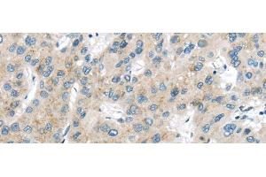 Immunohistochemistry of paraffin-embedded Human liver cancer using VPS26A Polyclonal Antibody at dilution of 1/40 (VPS26A 抗体)