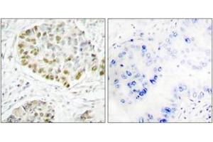 Immunohistochemistry analysis of paraffin-embedded human lung carcinoma tissue, using STAT5A (Ab-725) Antibody. (STAT5A 抗体  (AA 696-745))