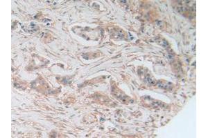 IHC-P analysis of Human Breast Cancer Tissue, with DAB staining. (AKT3 抗体  (AA 46-338))