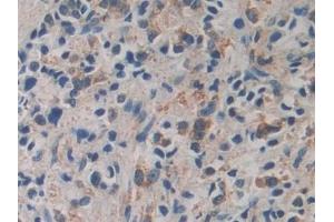 Detection of CACYBP in Human Prostate cancer Tissue using Polyclonal Antibody to Calcyclin Binding Protein (CACYBP)