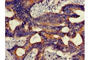 Immunohistochemistry of paraffin-embedded human colon cancer using ABIN7163904 at dilution of 1:100 (HMBS 抗体  (AA 283-330))