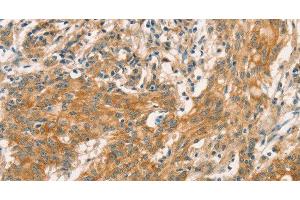 Immunohistochemistry of paraffin-embedded Human gastric cancer tissue using CPA2 Polyclonal Antibody at dilution 1:40 (Carboxypeptidase A2 抗体)