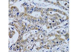 Immunohistochemistry of paraffin-embedded Human colon carcinoma using TPPP3 Polyclonal Antibody at dilution of 1:100 (40x lens). (TPPP3 抗体)