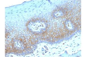 Formalin-fixed, paraffin-embedded human CervicalCarcinoma stained with Thrombomodulin/CD141 Mouse Monoclonal Antibody (THBD/1782). (Thrombomodulin 抗体  (AA 69-194))