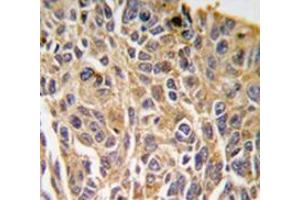 Immunohistochemistry analysis in human lung carcinoma tissue (Formalin-fixed, Paraffin-embedded) using RIPK3 / RIP3  Antibody (N-term), followed by peroxidase-conjugated secondary antibody and DAB staining. (RIPK3 抗体  (N-Term))