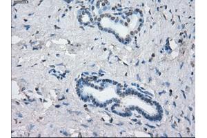 Immunohistochemical staining of paraffin-embedded Adenocarcinoma of colon tissue using anti-KDM4C mouse monoclonal antibody. (KDM4C 抗体)