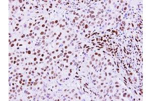 IHC-P Image RecQ1 antibody [N1N2], N-term detects RecQ1 protein at nucleus on human breast carcinoma by immunohistochemical analysis. (RecQ Protein-Like (DNA Helicase Q1-Like) (RECQL) (N-Term) 抗体)
