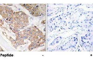 Immunohistochemical analysis of paraffin-embedded human breast carcinoma tissue using IL13RA1 polyclonal antibody . (IL13 Receptor alpha 1 抗体)