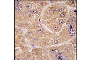 Formalin-fixed and paraffin-embedded human hepatocarcinoma tissue reacted with FUCA2 antibody (N-term) (Cat#AP14356PU-N), which was peroxidase-conjugated to the secondary antibody, followed by DAB staining. (FUCA2 抗体  (N-Term))