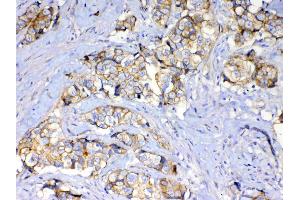 IHC analysis of beta Catenin using anti-beta Catenin antibody . (CTNNB1 抗体  (AA 2-233))