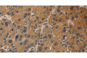 Immunohistochemistry of paraffin-embedded Human liver cancer tissue using DUSP23 Polyclonal Antibody at dilution 1:30 (DUSP23 抗体)