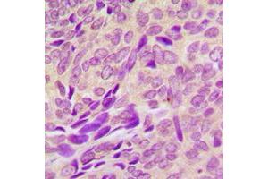 Immunohistochemical analysis of RAB41 staining in human breast cancer formalin fixed paraffin embedded tissue section. (RAB41 抗体  (Center))