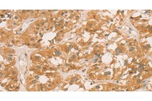 Immunohistochemistry of paraffin-embedded Human thyroid cancer tissue using CPB1 Polyclonal Antibody at dilution of 1:60 (CPB1 抗体)