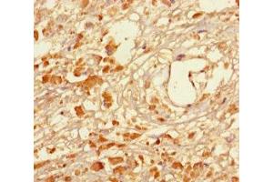 Immunohistochemistry of paraffin-embedded human melanoma using ABIN7159268 at dilution of 1:100 (MAGEA5 抗体  (AA 1-124))
