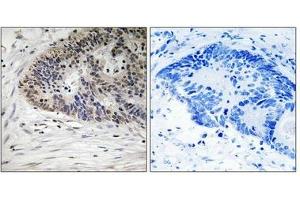 Immunohistochemistry analysis of paraffin-embedded human colon carcinoma tissue using MDM4 (Phospho-Ser367) antibody. (MDM4-binding Protein 抗体  (pSer367))