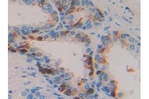 Detection of TGFa in Human Prostate Tissue using Polyclonal Antibody to Transforming Growth Factor Alpha (TGFa) (TGFA 抗体  (AA 24-98))