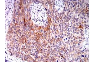 Immunohistochemical analysis of paraffin-embedded cervical cancer tissues using CPV-VP2 mouse mAb with DAB staining. (CPV-VP2 (AA 1-128) 抗体)