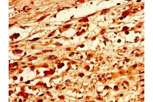 Immunohistochemistry of paraffin-embedded human melanoma using ABIN7162511 at dilution of 1:100 (PAX9 抗体  (AA 163-336))