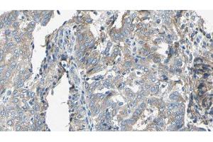 ABIN6276761 at 1/100 staining Human cervical cancer tissue by IHC-P. (TAP2 抗体  (Internal Region))