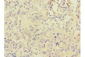 Immunohistochemistry of paraffin-embedded human liver cancer using ABIN7146291 at dilution of 1:100 (Calcitonin Receptor 抗体  (AA 25-148))