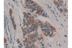 Detection of GAL3ST1 in Human Breast cancer Tissue using Polyclonal Antibody to Galactose-3-O-Sulfotransferase 1 (GAL3ST1) (GAL3ST1 抗体  (AA 57-196))