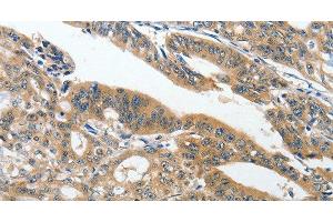 Immunohistochemistry of paraffin-embedded Human gasrtic cancer tissue using ANKZF1 Polyclonal Antibody at dilution 1:40 (ANKZF1 抗体)