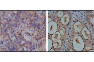 Immunohistochemical analysis of paraffin-embedded human breast carcinoma (left) and kidney carcinoma (right), showing cytoplasmic localization using GAPDH antibody with DAB staining. (GAPDH 抗体)
