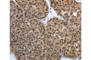 Immunohistochemistry of Human thyroid cancer using SMAD7 Polyclonal Antibody at dilution of 1:40 (SMAD7 抗体)