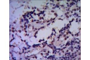 Immunohistochemical analysis of paraffin-embedded human breast cancer using HSP70 mouse mAb with DAB staining. (HSP70 抗体)