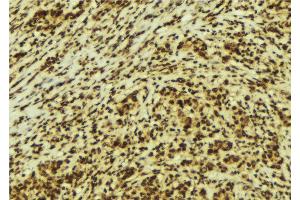 ABIN6274149 at 1/100 staining Human breast cancer tissue by IHC-P. (HMGN2 抗体  (Internal Region))